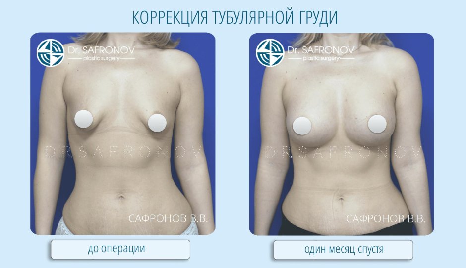 Треугольная тубулярная грудь