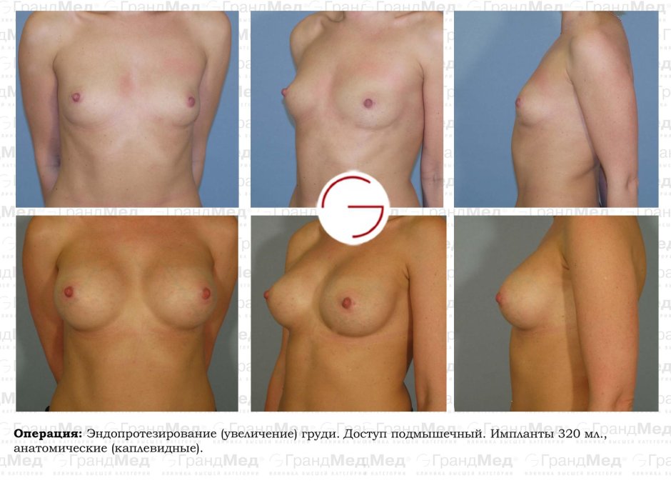 Каплевидная грудь