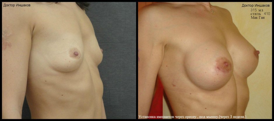 Пластика груди до и после