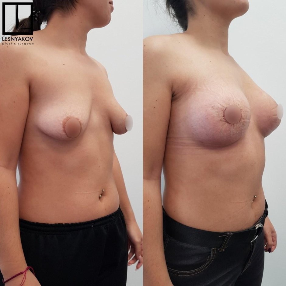 Тубулярная форма молочной железы