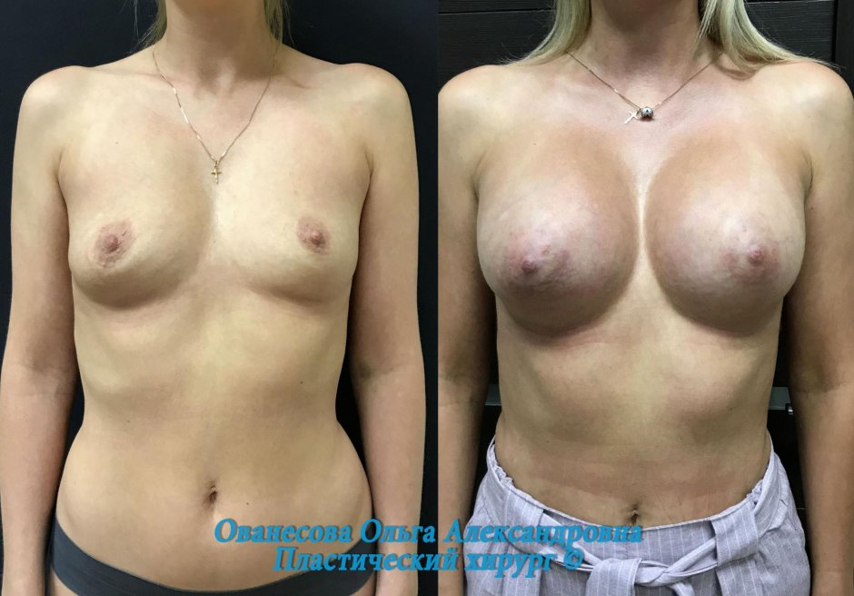 Грудь до и после увеличения