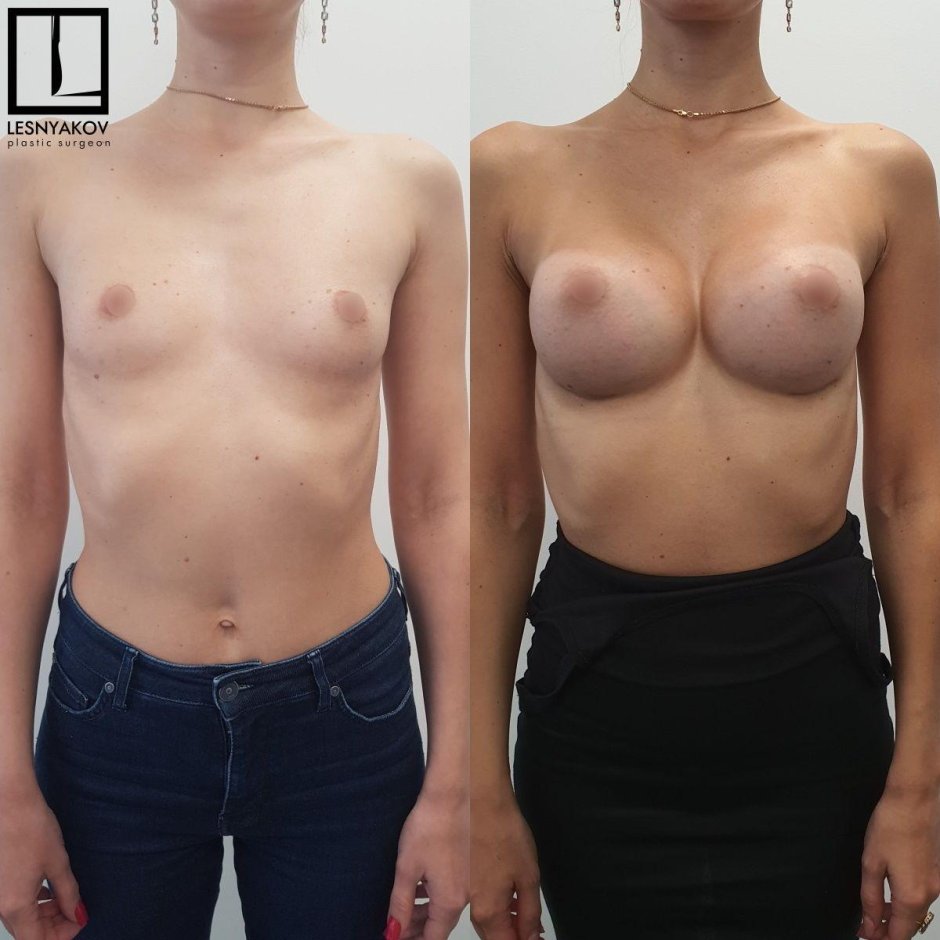 Маммопластика до и после