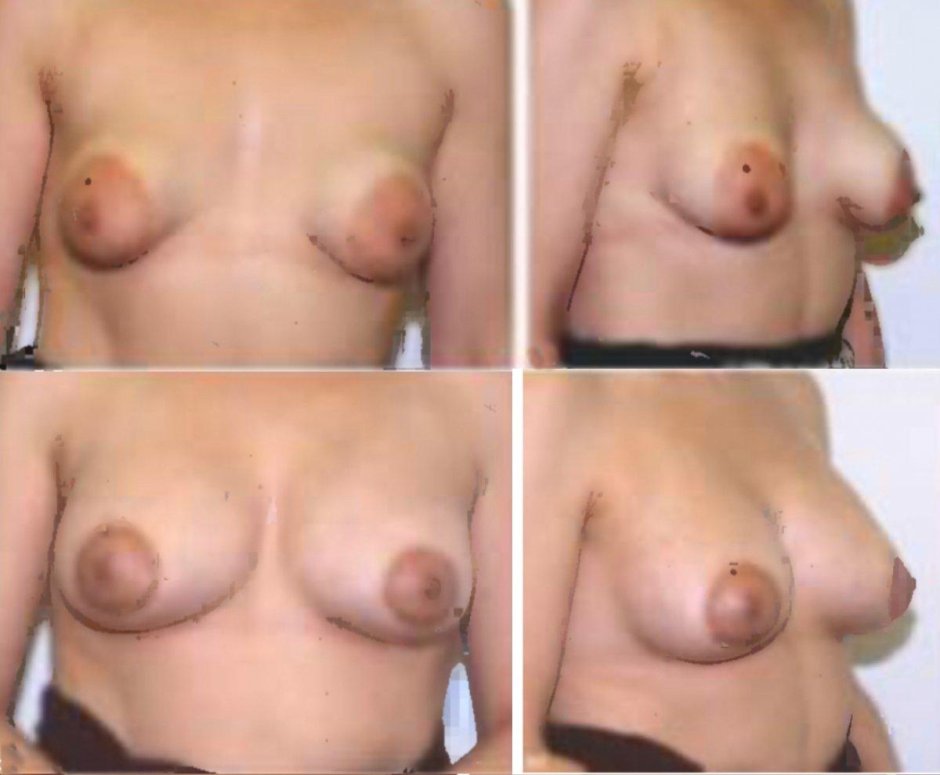 Тубулярная форма молочных желез