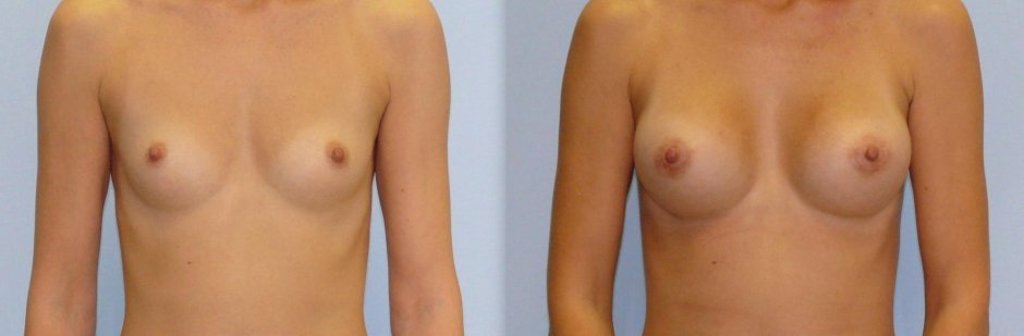 Увеличенная грудь