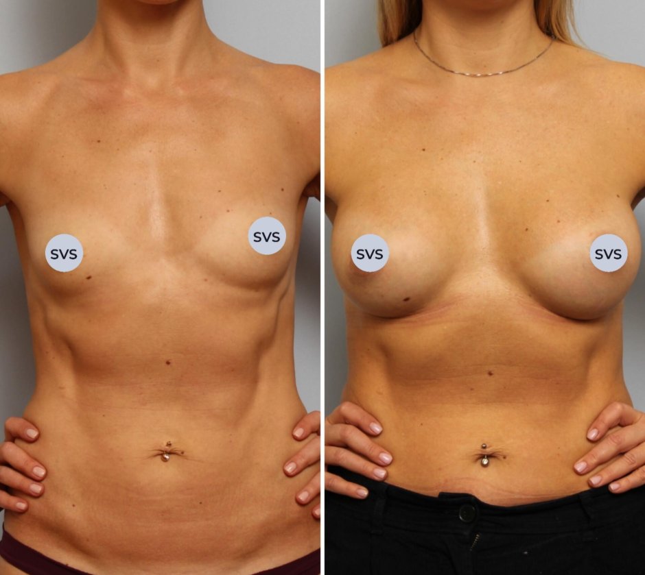 Порноактрисы увеличившая.грудь