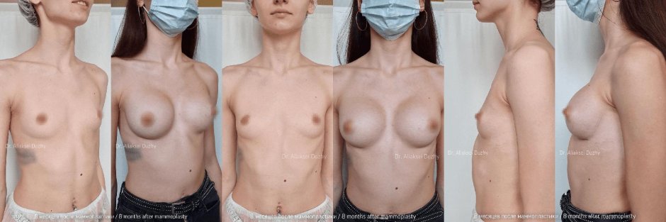 Маммопластика груди