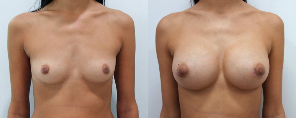 Увеличенная грудь