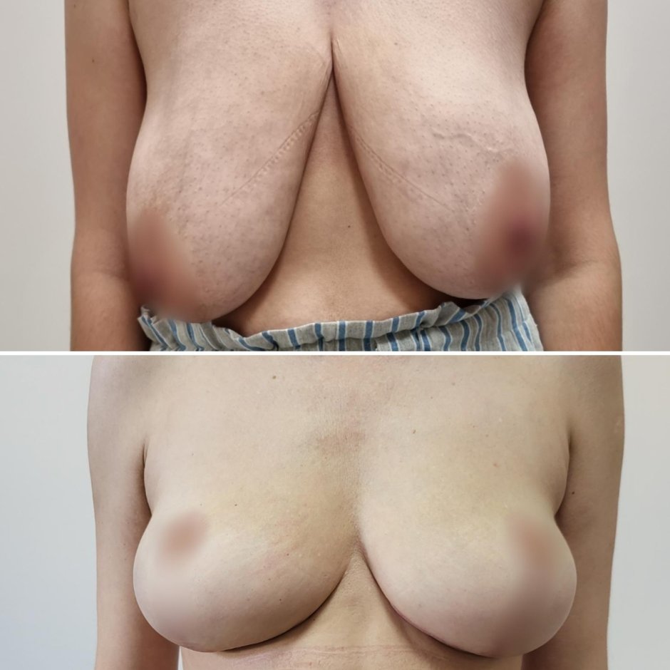 Уменьшение груди