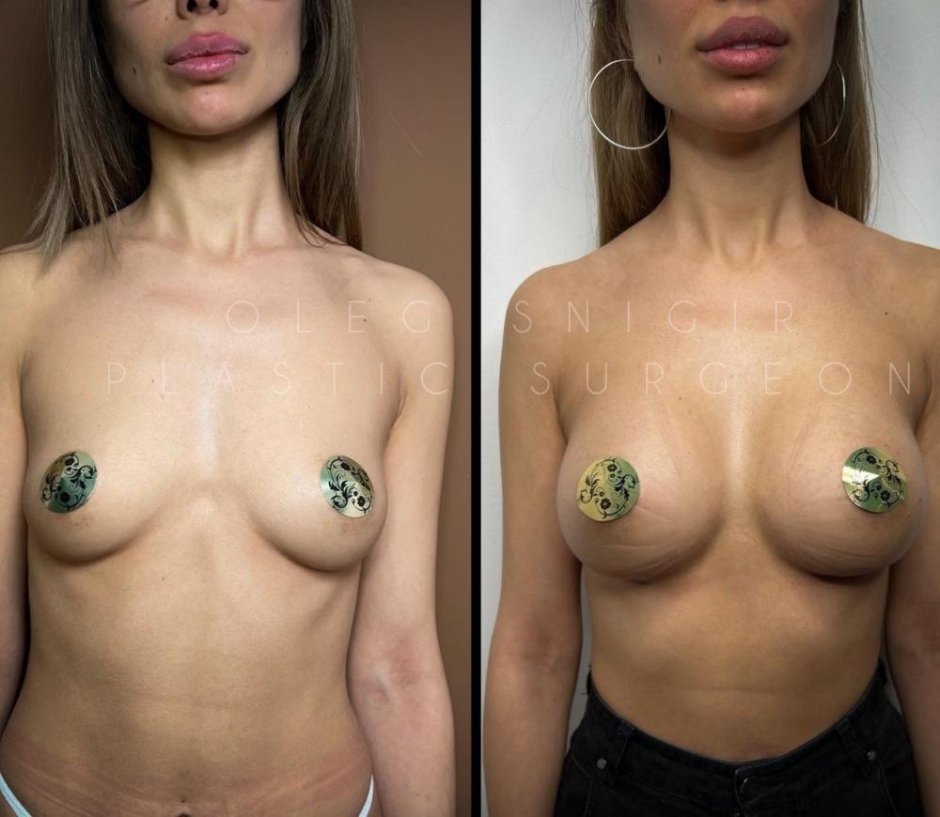 Маммопластика капсулярная контрактура