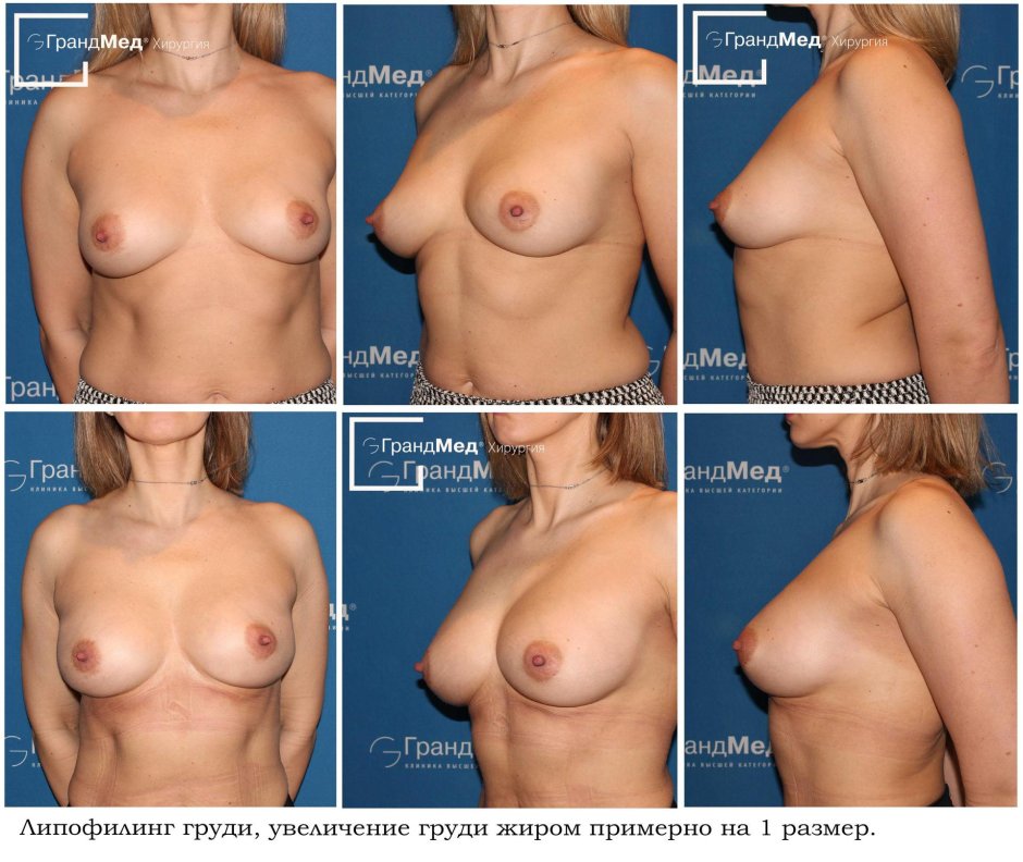 Увеличение груди с помощью жира