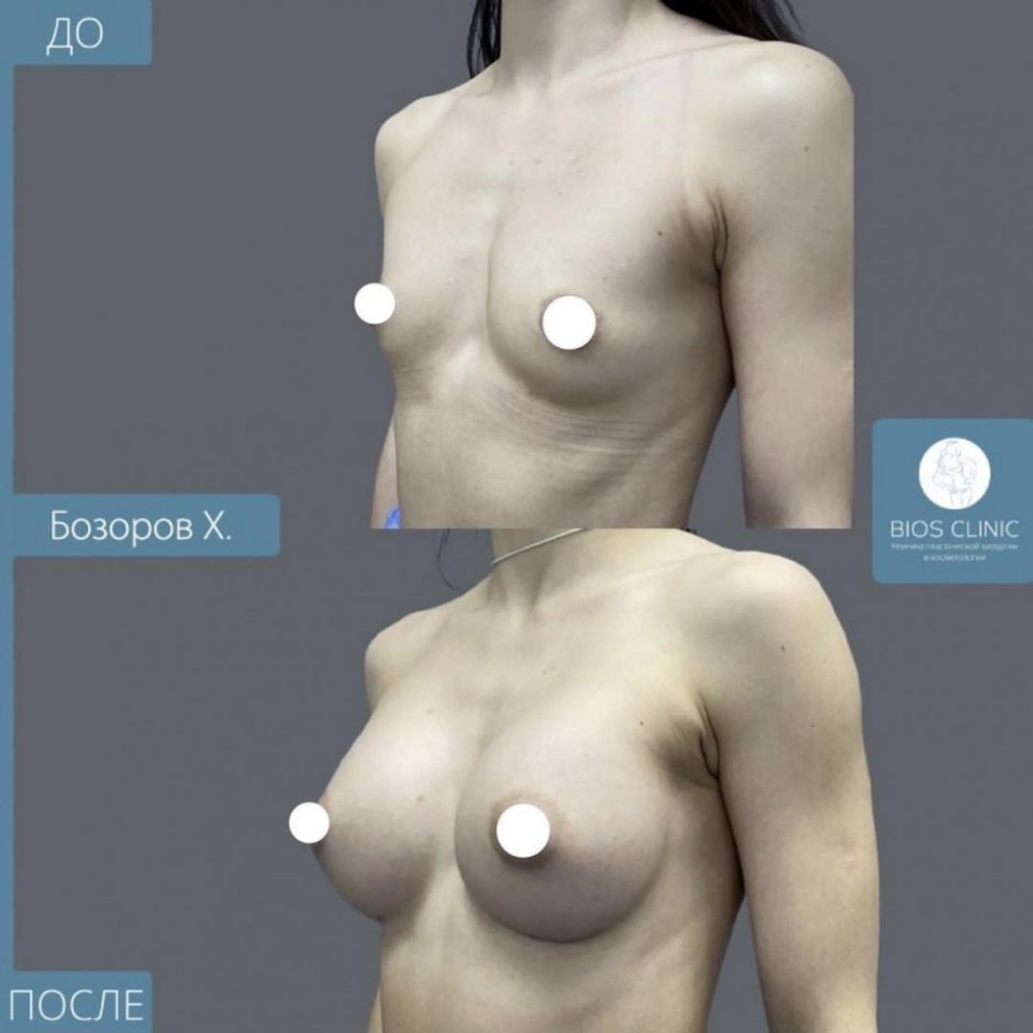 Подтяжка и увеличение груди