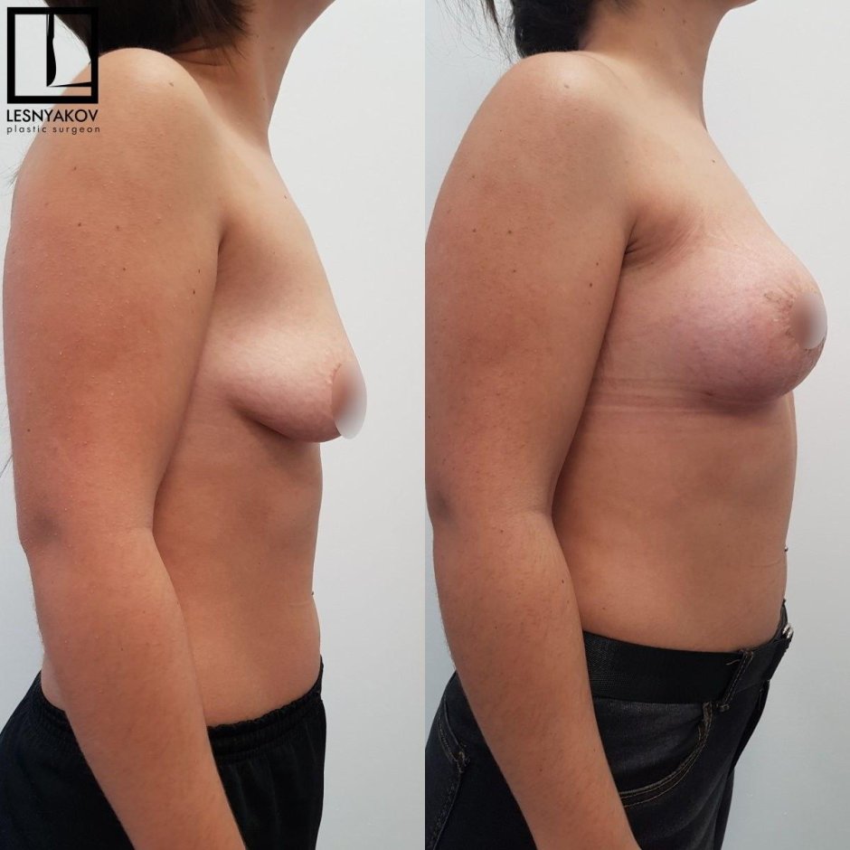 Тубулярная деформация молочных