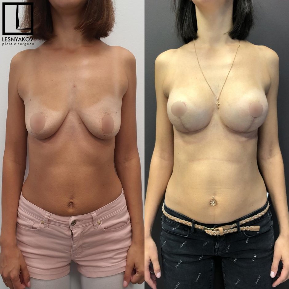 До и после подтяжки груди