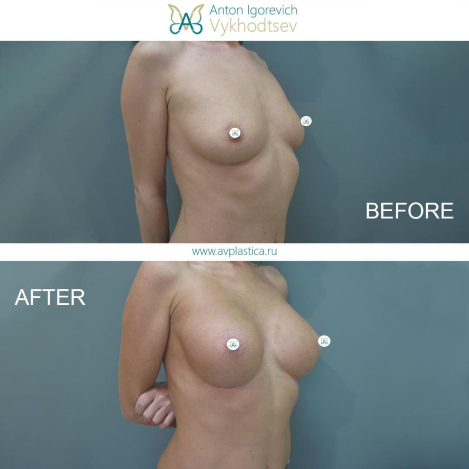 Гинекомастия операция