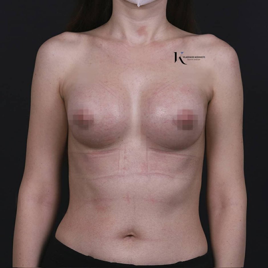 Операция по увеличению груди