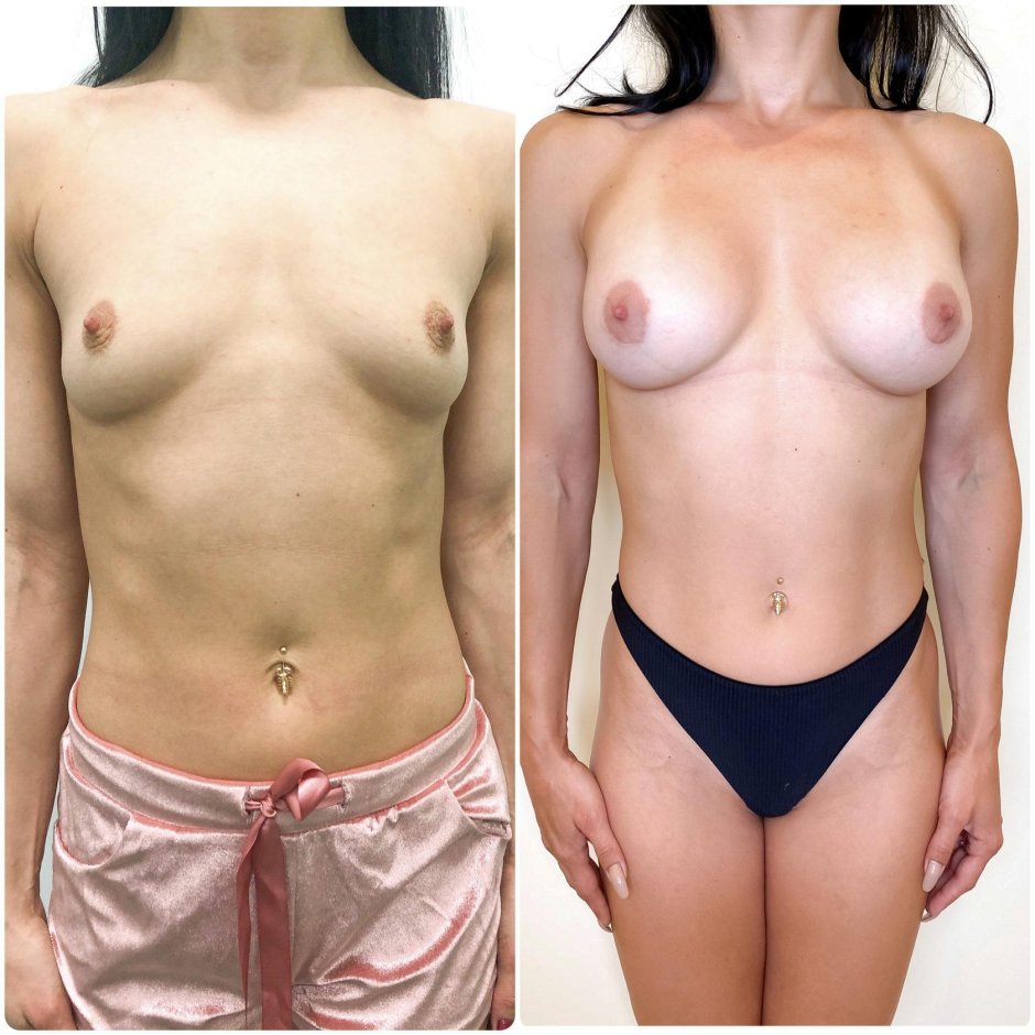 Сиськи до и после имплантов
