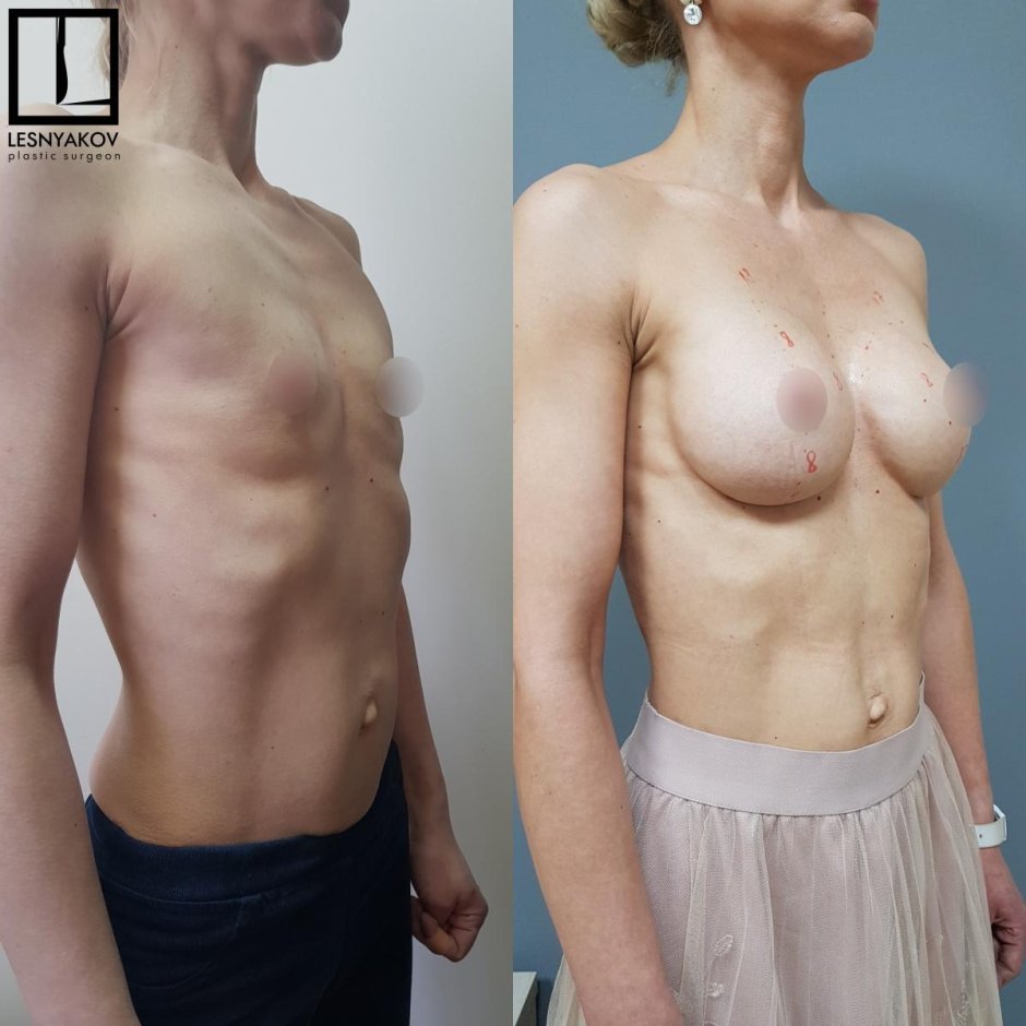 Ложная гинекомастия