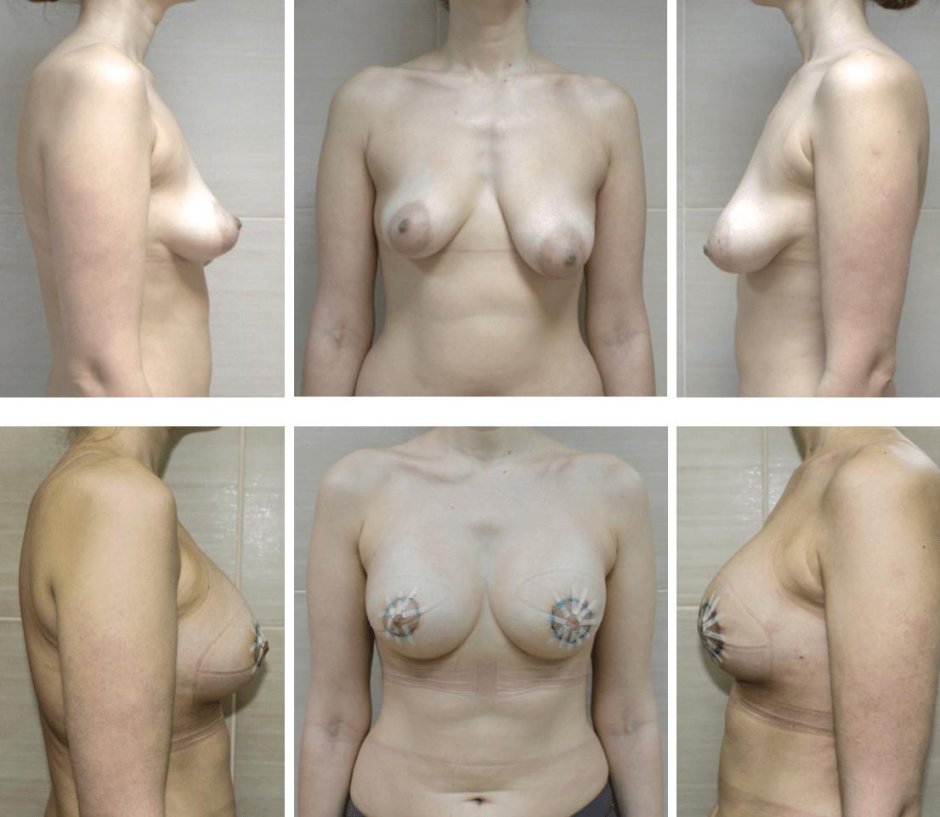 Анатомические импланты