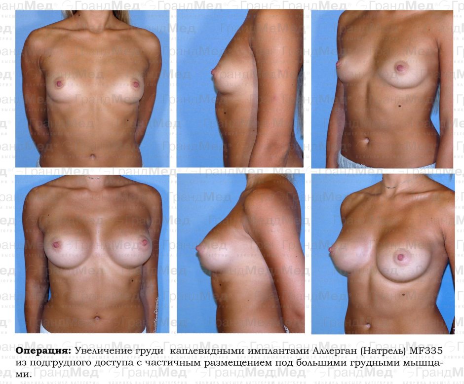 Сиськи после операции