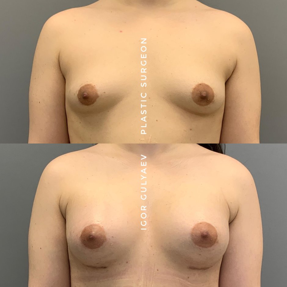 Грудь тубулярная