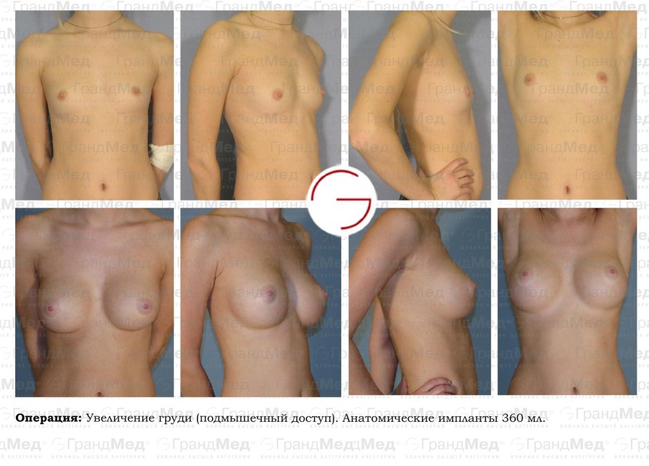 Операция увеличение груди