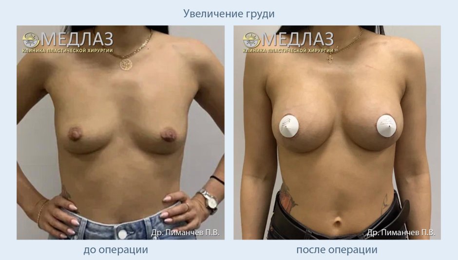 Грудь импланты