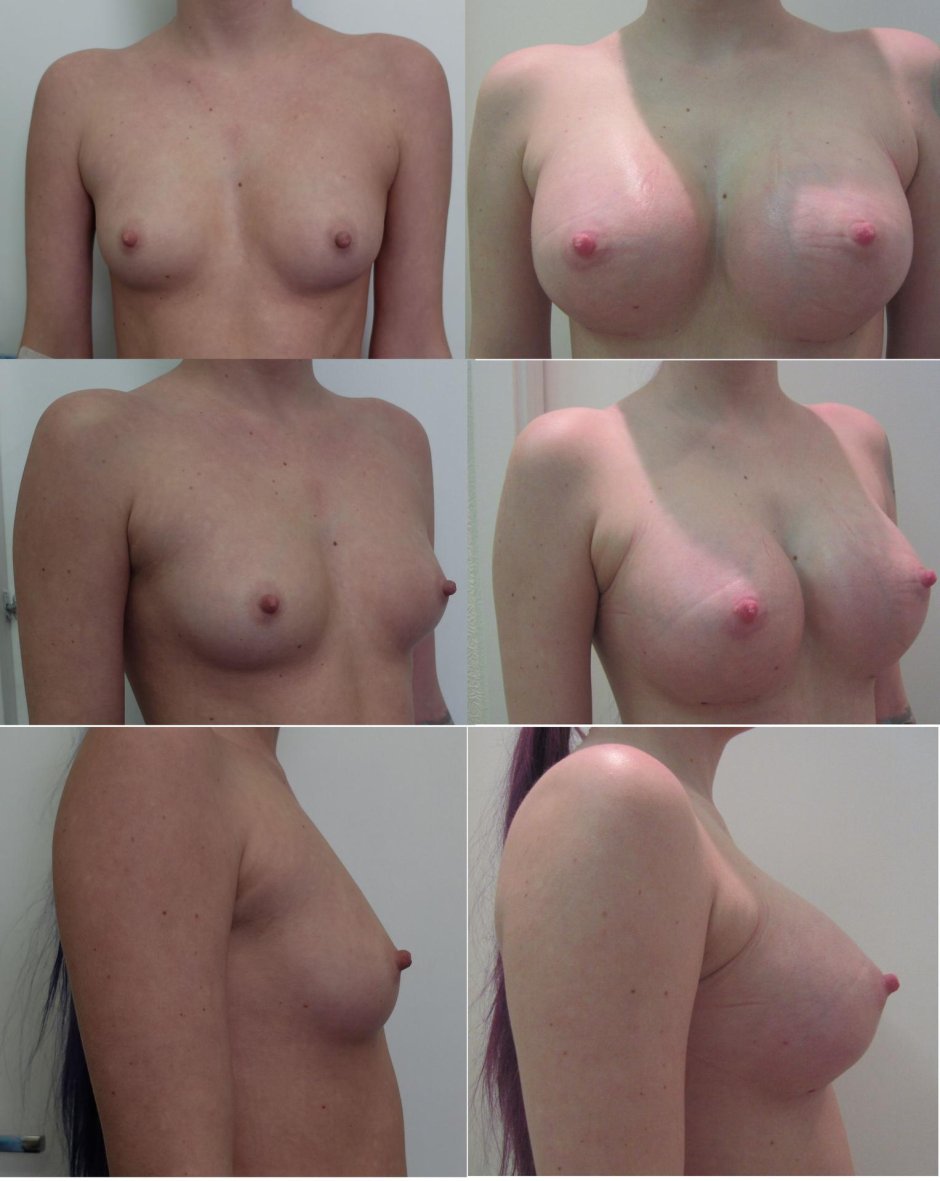 Голые сиськи до и после операции