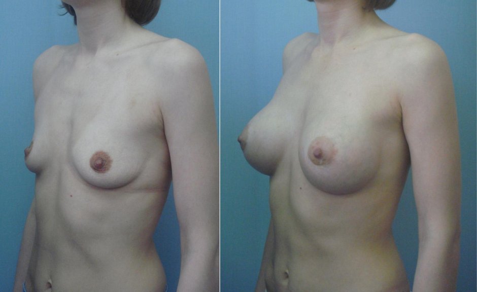До и после увеличения груди