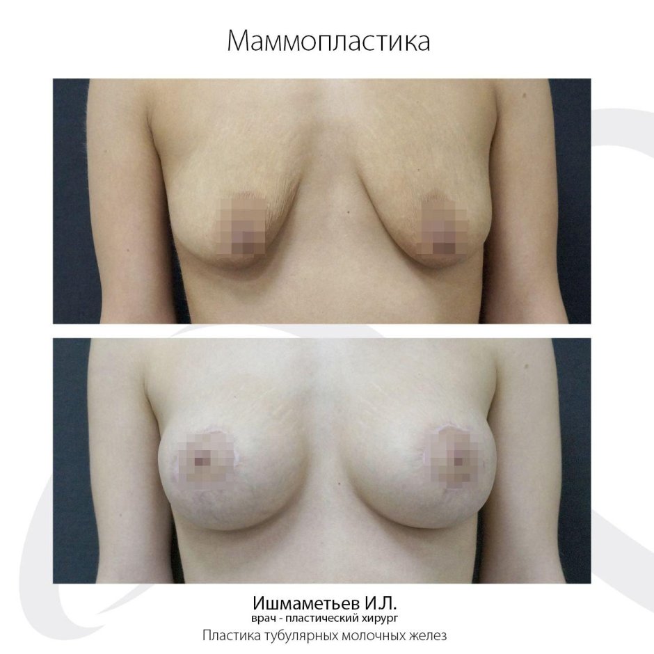 Периареолярная мастопексия