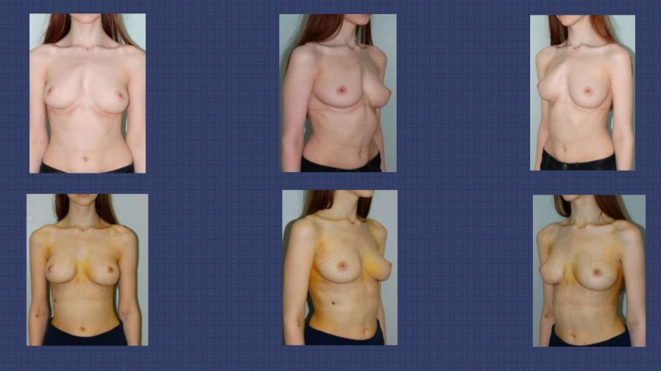 Деформация грудной клетки у девочек