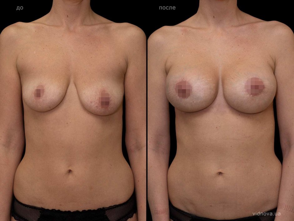 Асимметрия женской груди