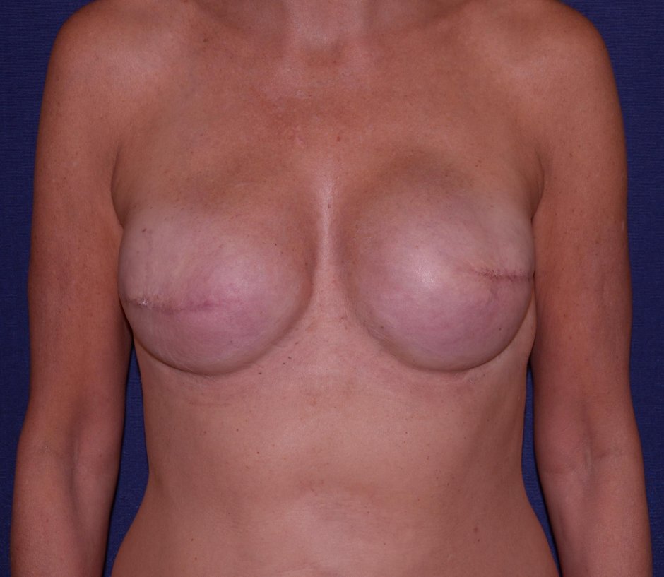 Конусообразная грудь