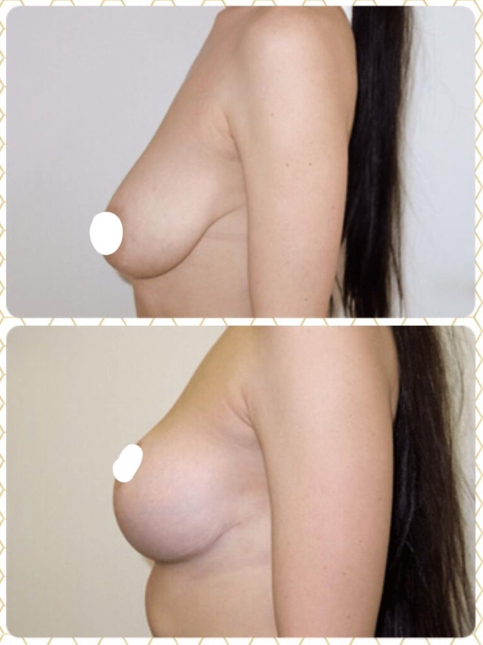 Конусовидная грудь