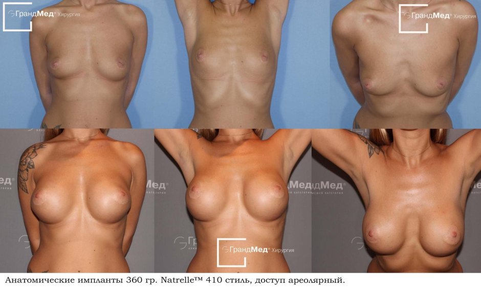 Увеличение груди