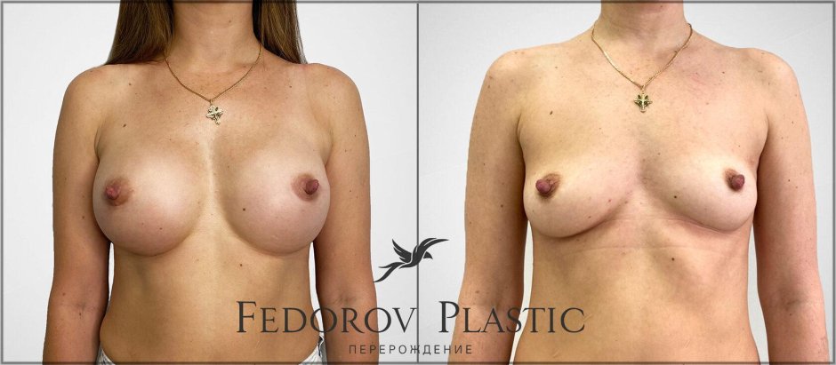Увеличенная грудь