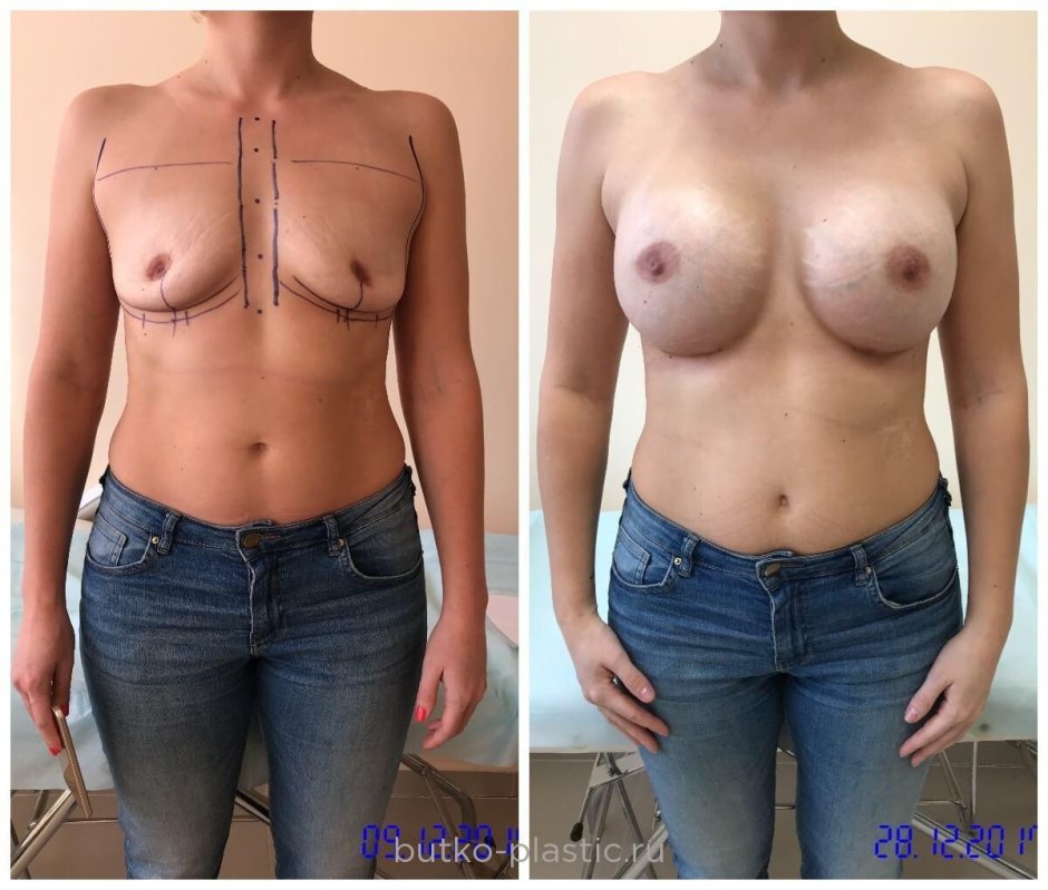 Силиконовая грудь операция