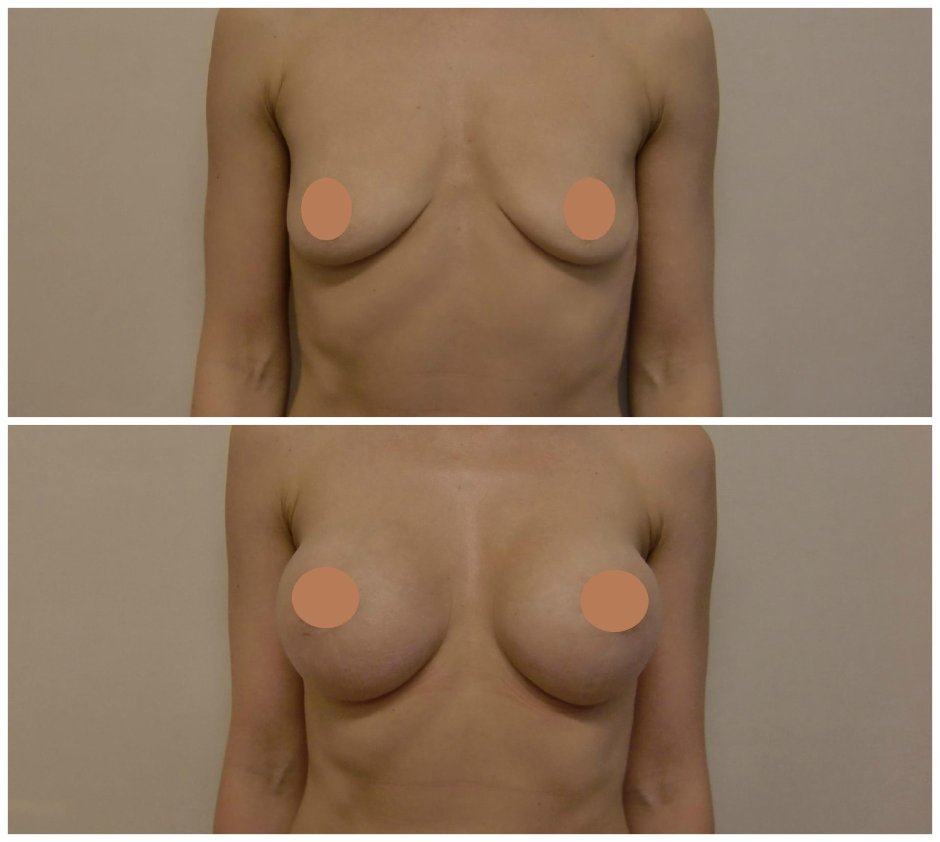 Коррекция груди