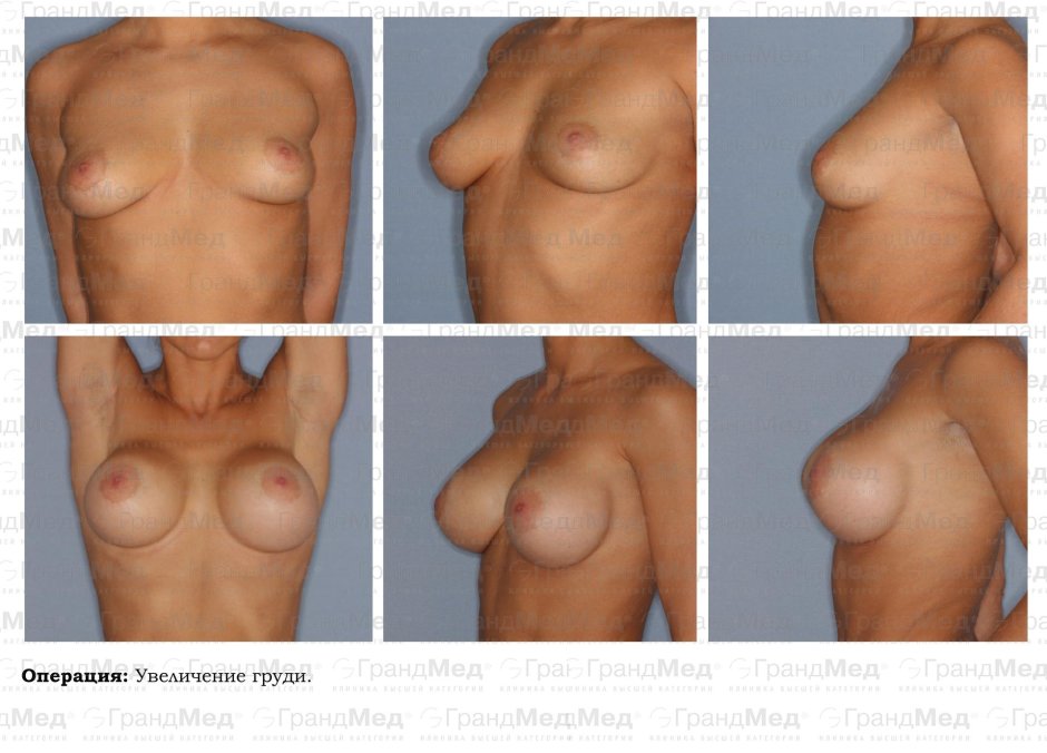 Операция на увеличение груди