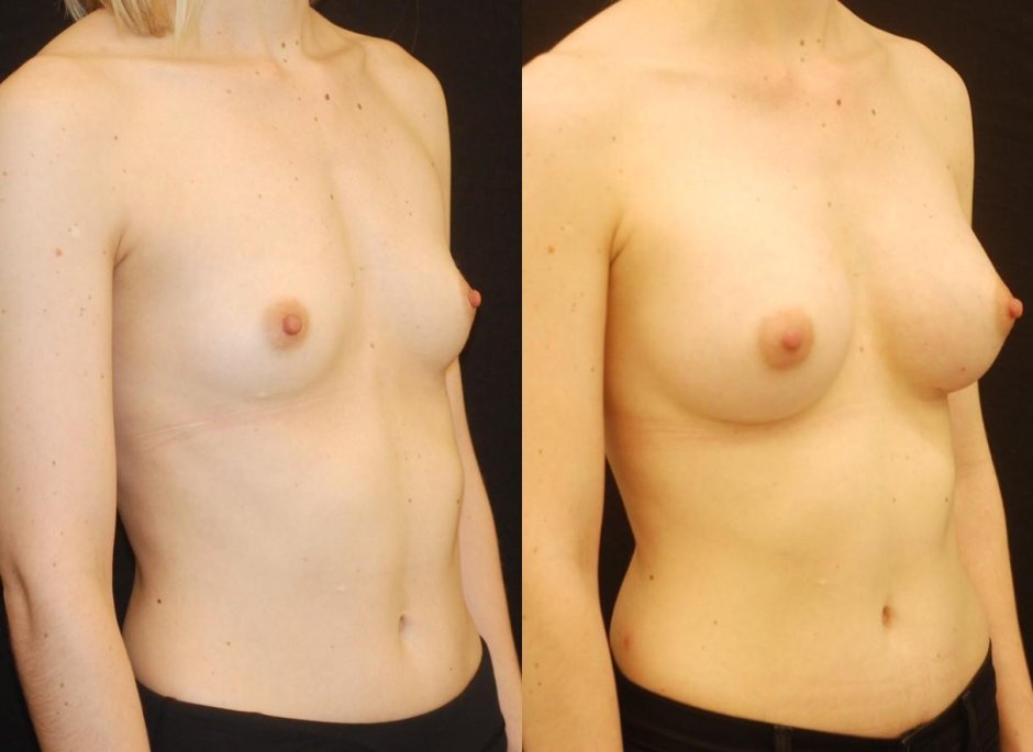 Микромастия голая грудь