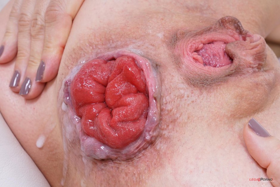 Синди роуз гаппинг пролапс