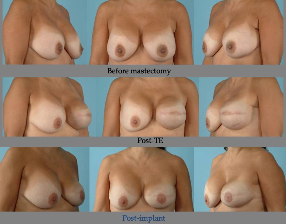 До и после увеличения груди