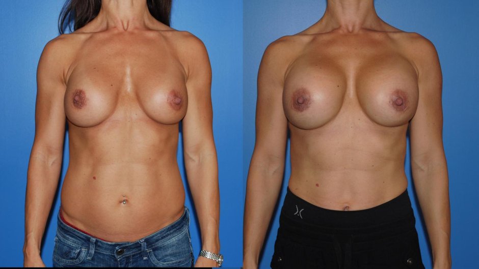 Увеличение груди собственным жиром
