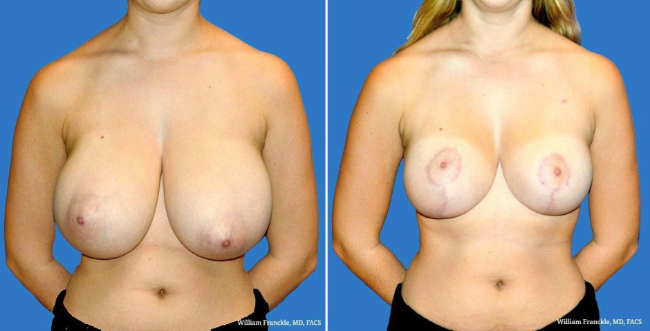 Macromastia areolas