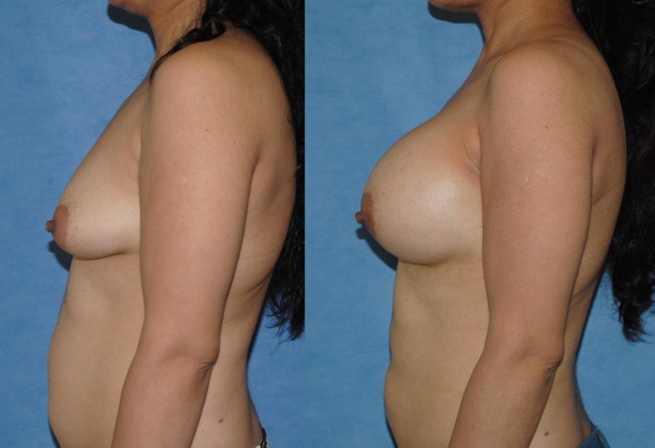 Breast surgery