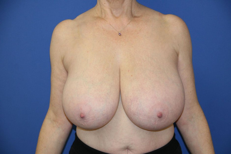 Breast surgery