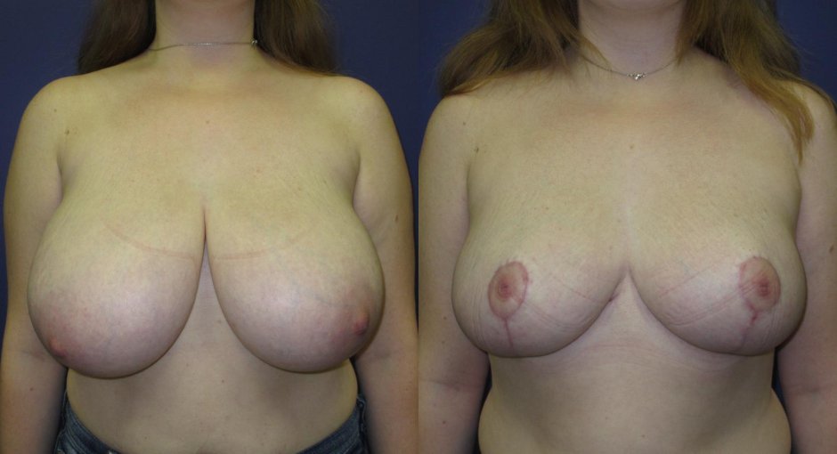 Breast surgery