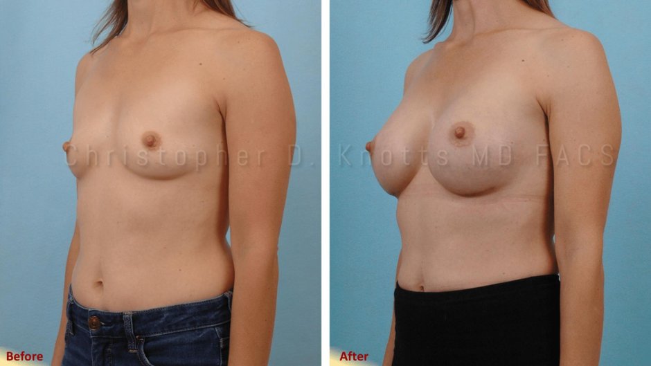 Гинекомастия до и после операции