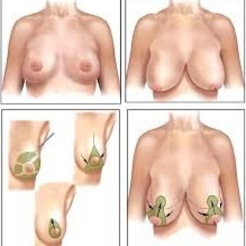 Конусовидная грудь