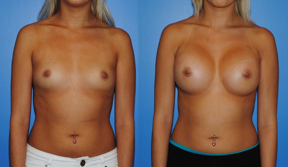 Грудь пластика