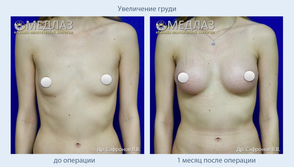 Увеличение груди с помощью жира